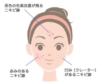 色素 ニキビ 沈着 跡 茶色の色素沈着ニキビ跡を消す方法とは？